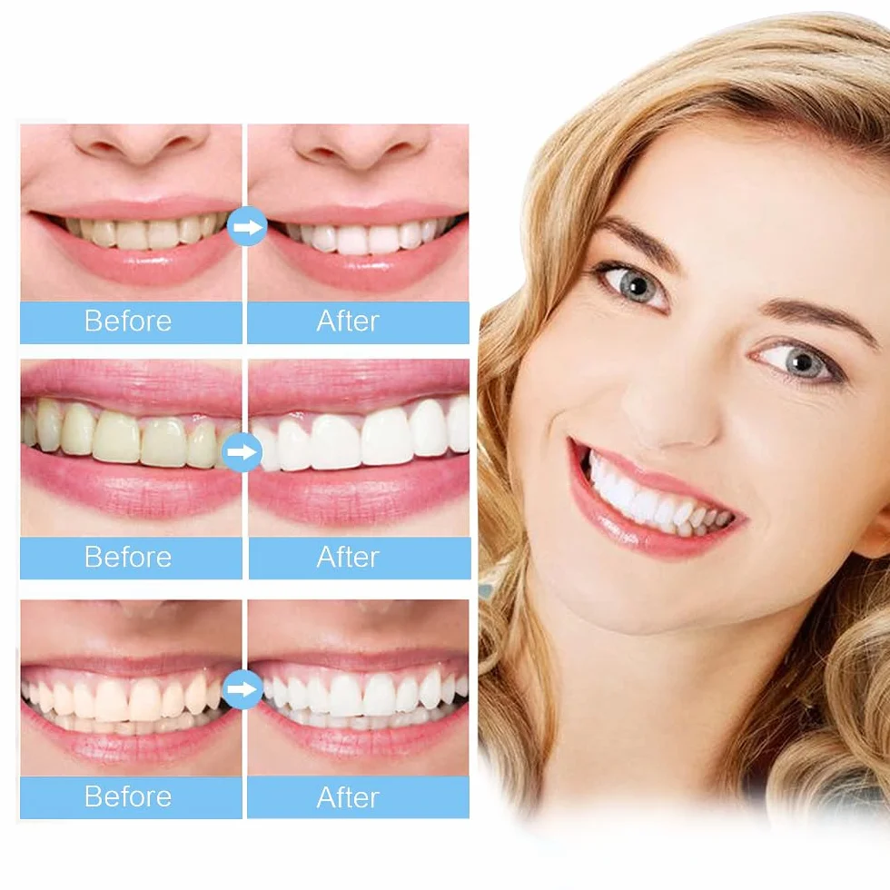 Vernice dentale sbiancante istantaneo per denti bianchi