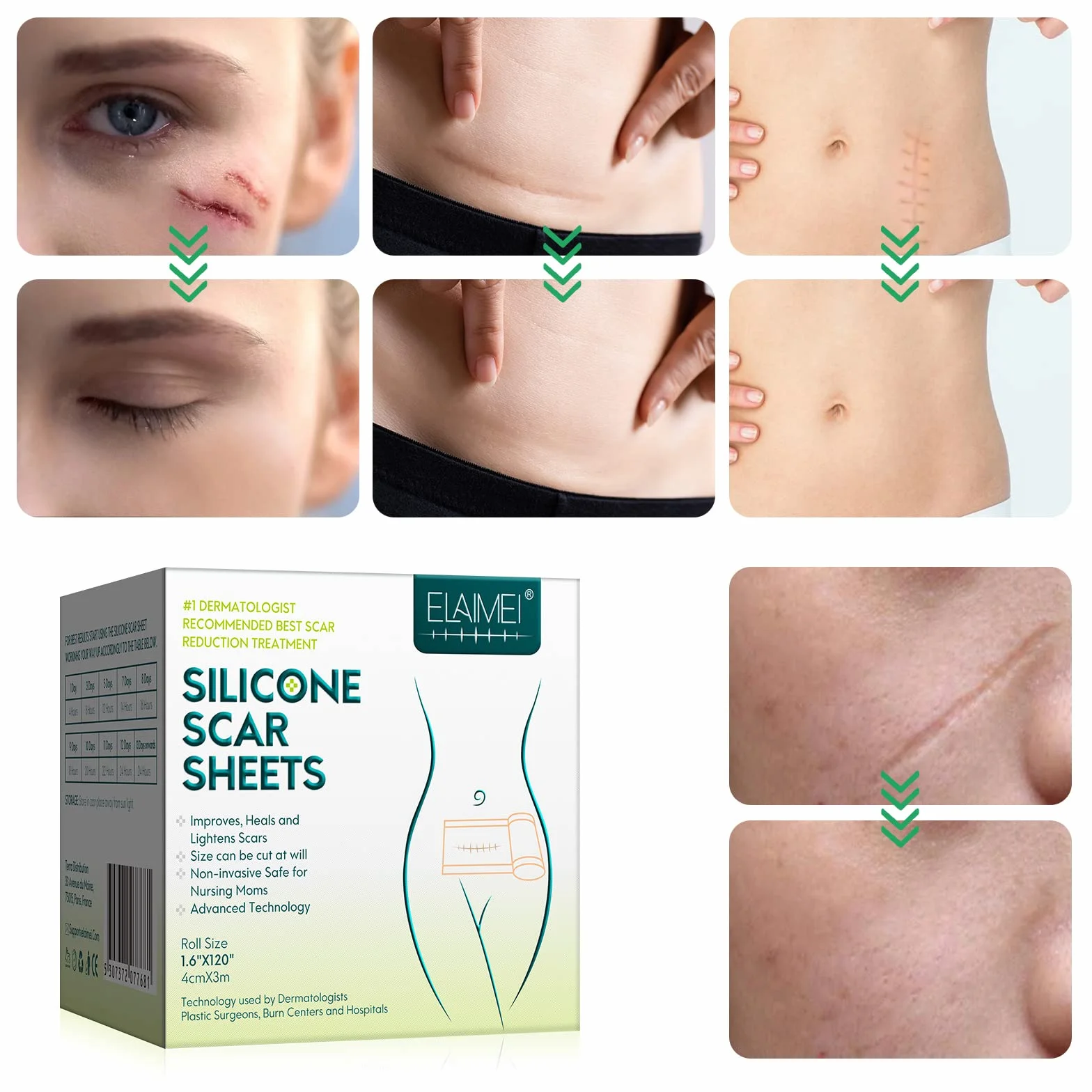 Fogli Cicatriziali in Silicone 4x300cm per Cicatrici da Cesareo, Chirurgia, Ustioni, Cheloidi, Acne