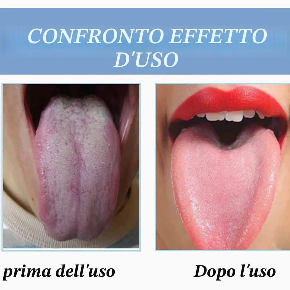 Raschietti per Lingua in Acciaio Inossidabile, Pulitori a Forma di U, Riutilizzabile Strumenti per Igiene Orale