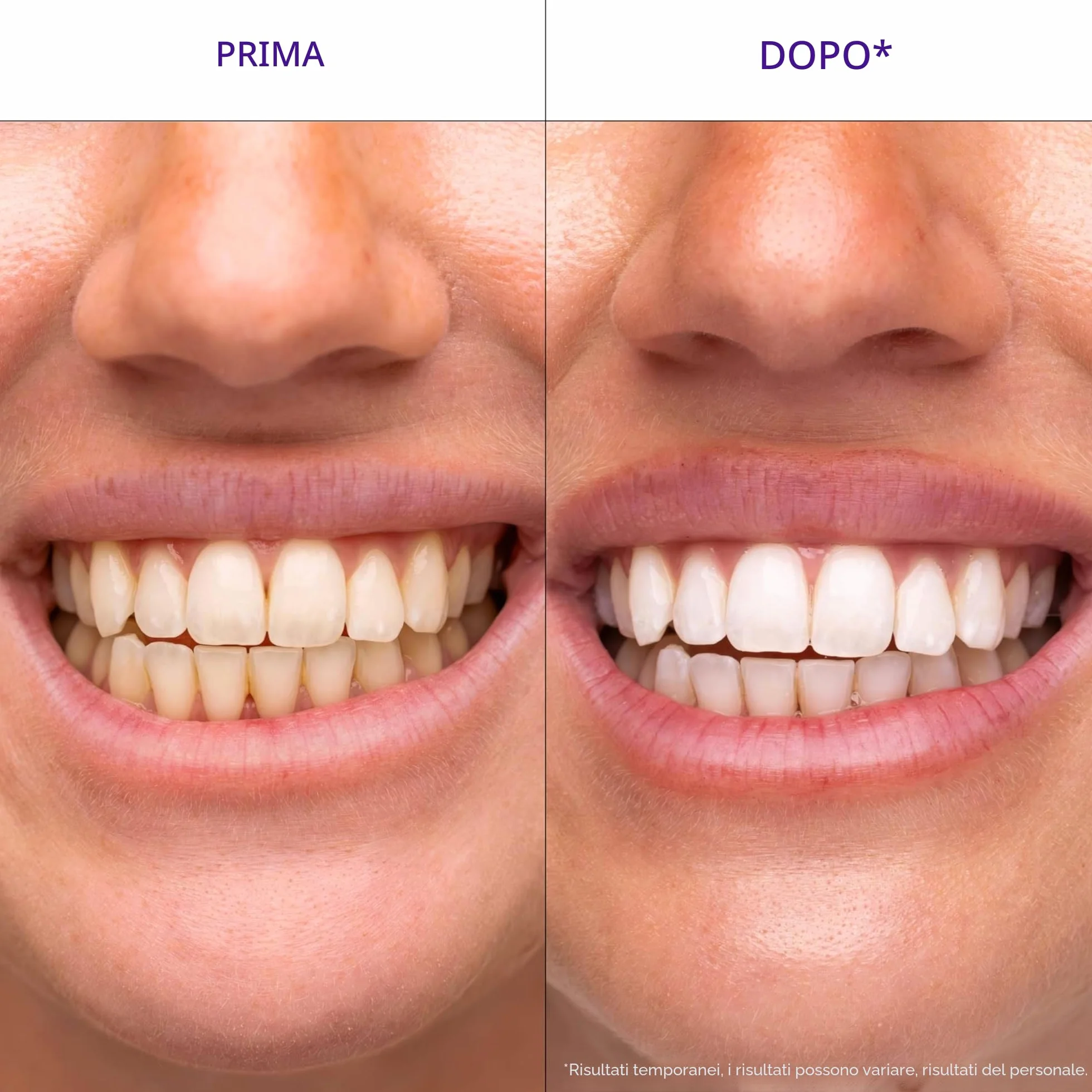 Hismile V34 Strisce Sbiancanti, Sbiancamento dei Denti, 14 Pezzi