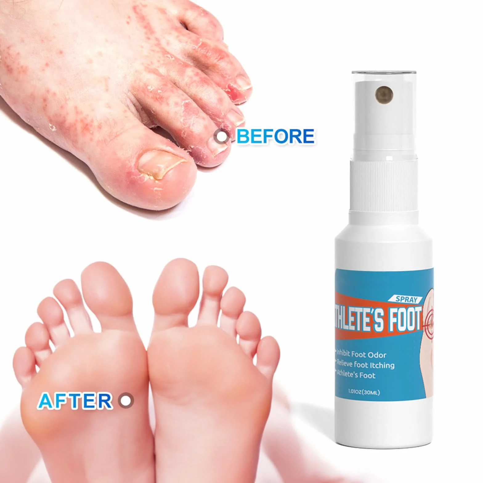 Spray antimicotico per la cura dei piedi, trattamento per prurito e screpolature
