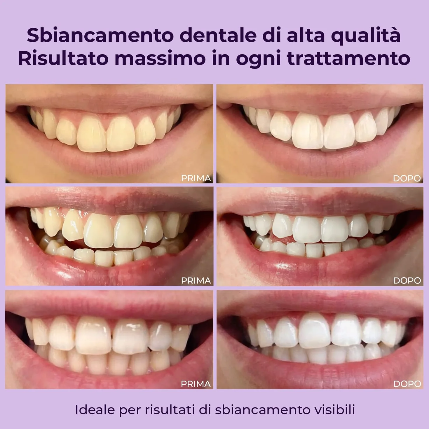 OnlySmile Gel Sbiancante Denti 2 Pezzi Sbiancamento Immediato