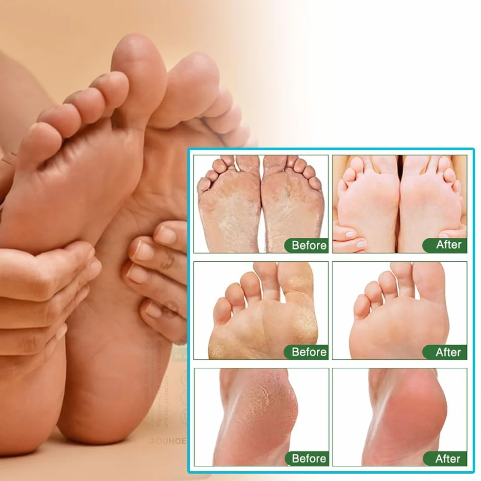 Spray Per Piedi E Unghie 2 Pcs Trattamento Del Piede Cura Dei Piedi 30ml
