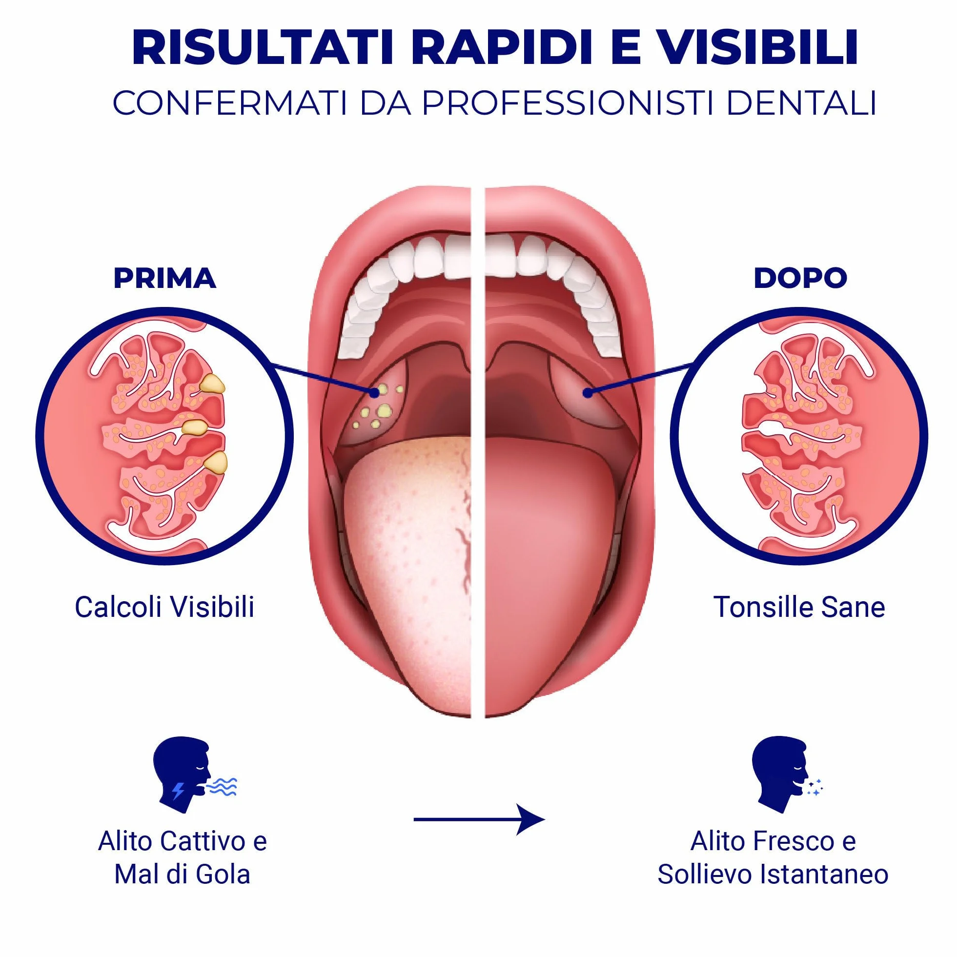 ORAVIX Kit per rimuovere calcoli tonsillari con luce LED, 3 beccucci, siringa e raschietto per lingua