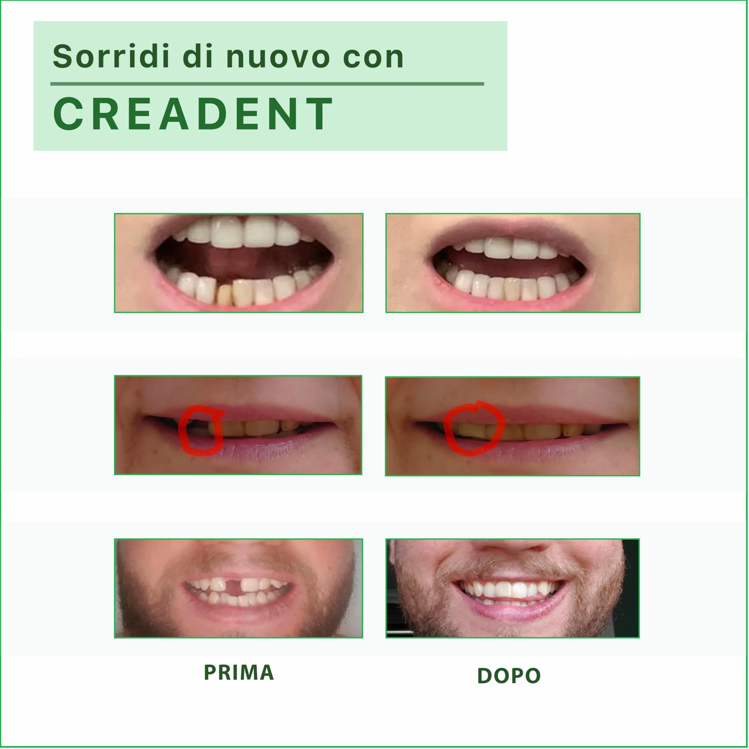 Creadent Kit per Sostituire un Dente Mancante