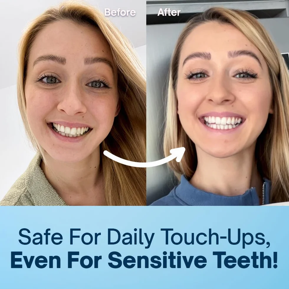 MySweetSmile Lápiz blanqueador dental de precisión - Fórmula Pap - Seguro para esmalte - Sin sensibilidad - Aprobado por dentistas