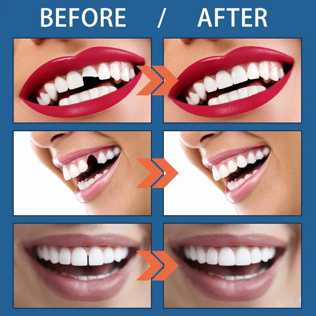 Dentiera Provvisoria Kit Riempimento Dente 25g