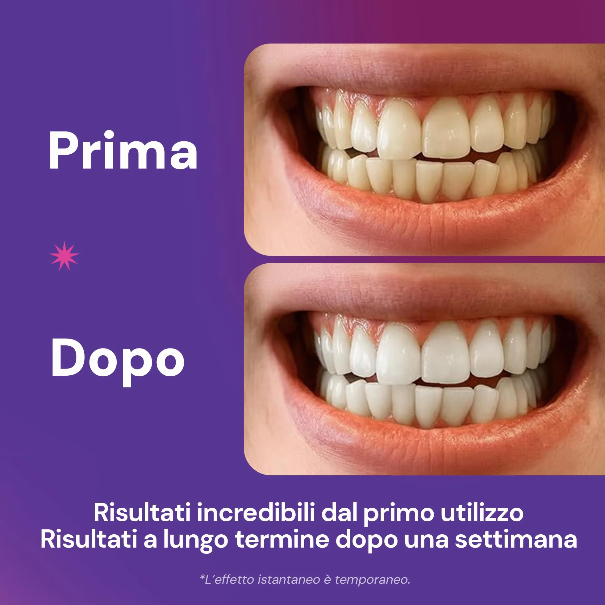 ESMILE 42 Strisce Sbiancanti Denti Professionali Viola - Sbiancamento Denti Rapido a Casa per Macchie da Caffè, Vino, Fumo