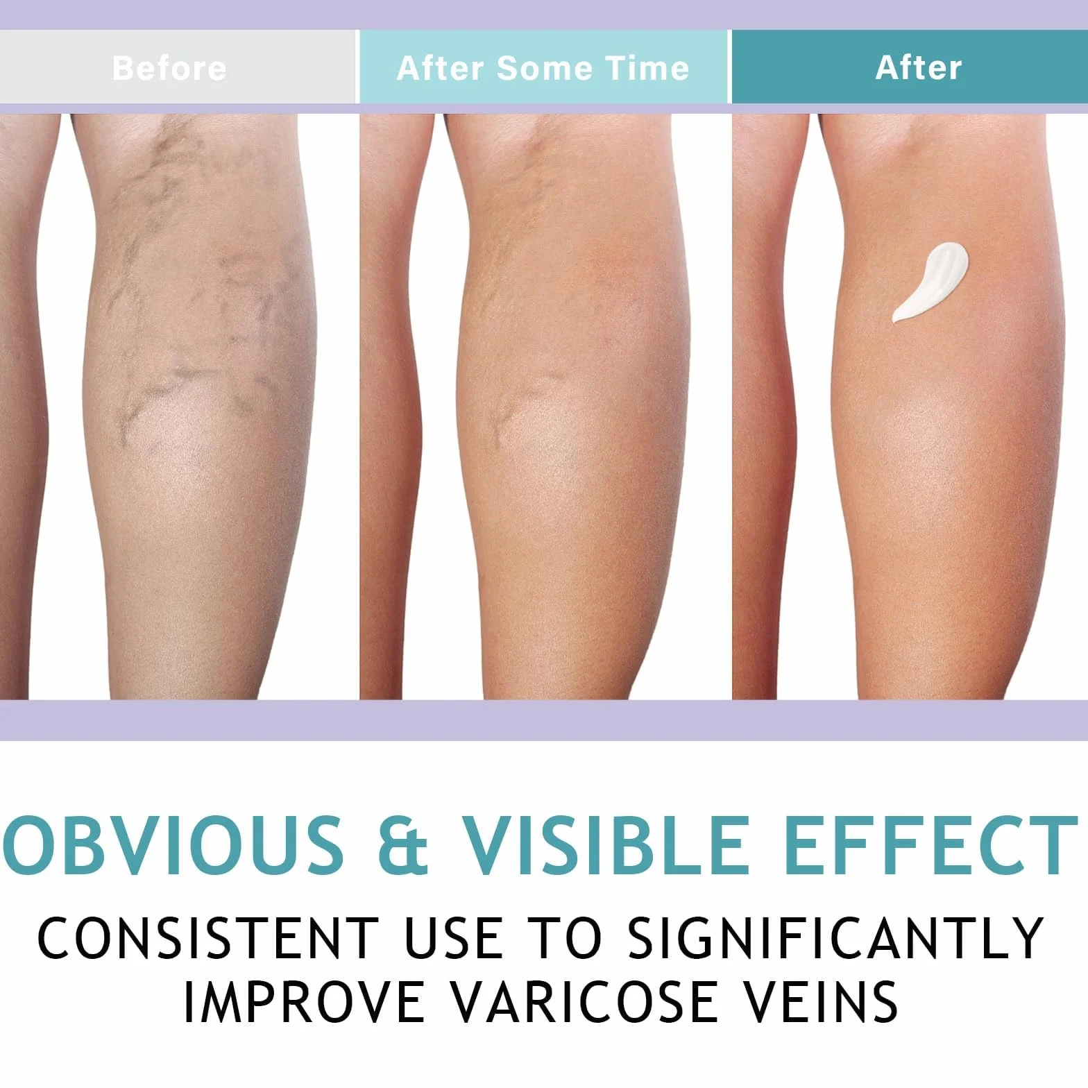 Crema Vene Varicose Migliora Circolazione Sanguigna Cura Capillari
