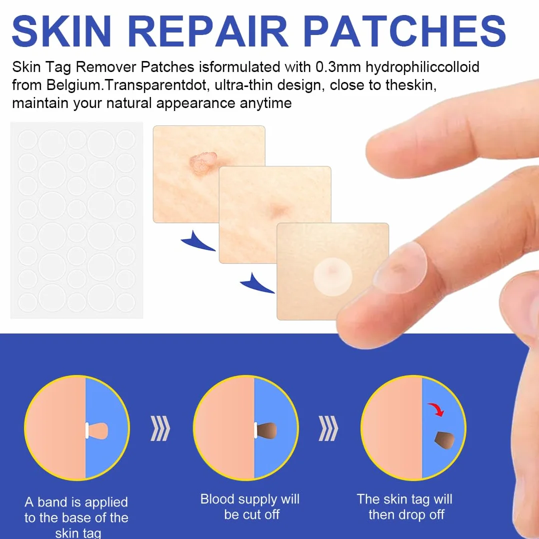 Skin Tag Fibromi Penduli Rimozione Set Efficace Indolore Della Pelle Talpe Sicuro Facile Rimuovere Piccole Grandi Blu
