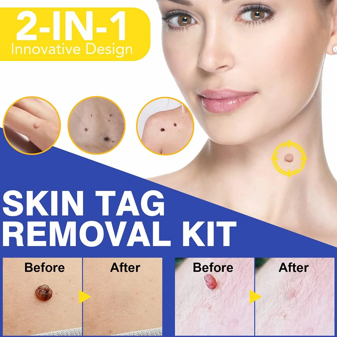 Skin Tag Fibromi Penduli Rimozione Set Efficace Indolore Della Pelle Talpe Sicuro Facile Rimuovere Piccole Grandi Blu