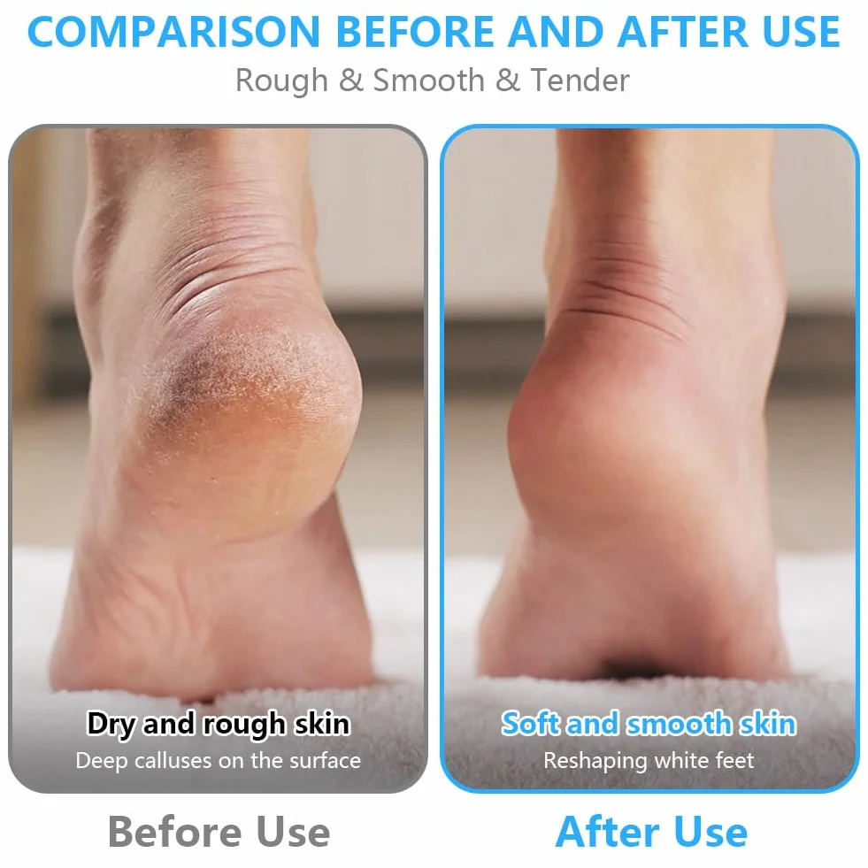 OSDUE Pedicure Elettrico Professionale con 3 Rulli Sostituibili, Rimozione Calli Ricaricabile 2 Velocità
