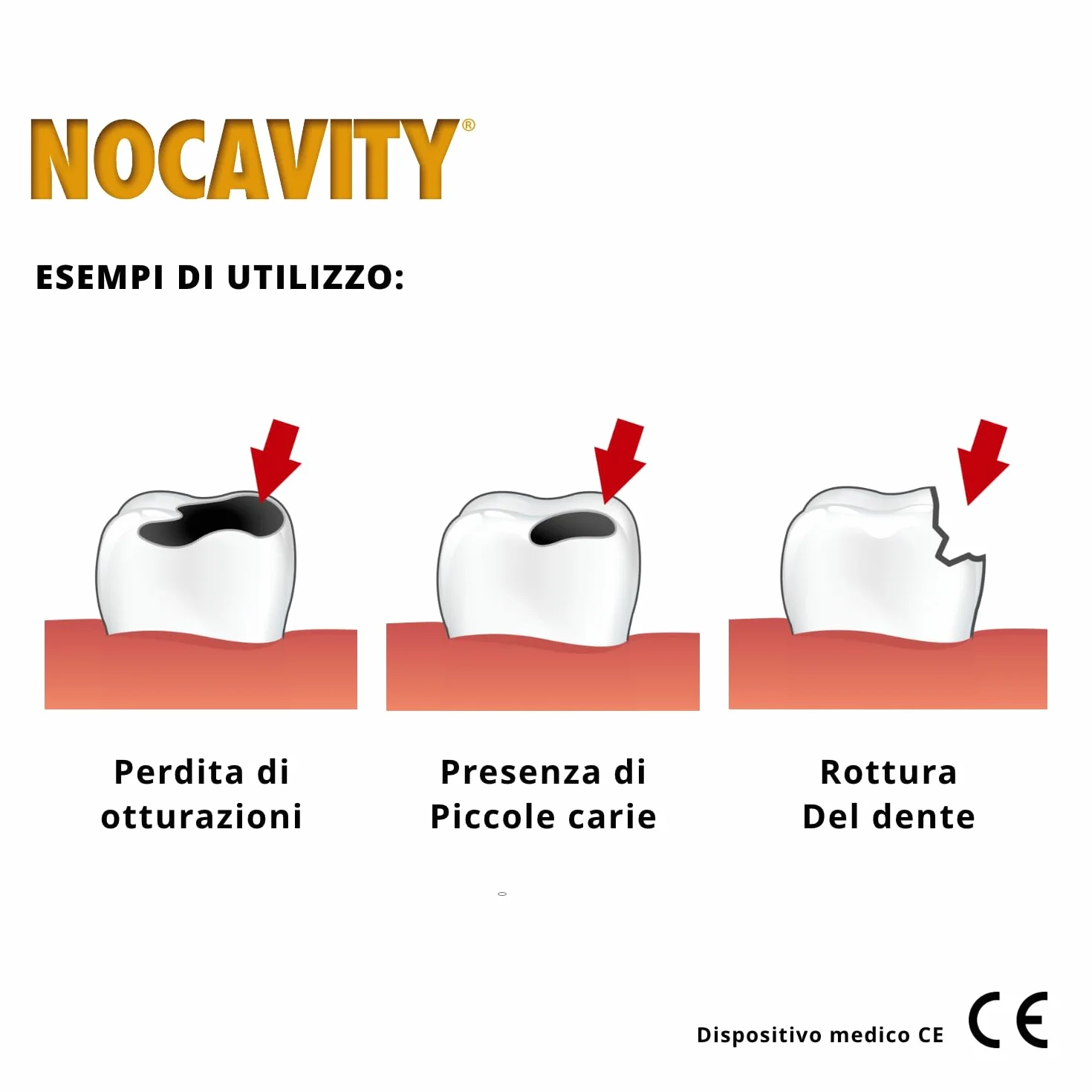 Kit per Otturazioni Dentali Provvisorie - Cemento Isolante Cavità Dentale per Dolore, Carie e Denti Rotti