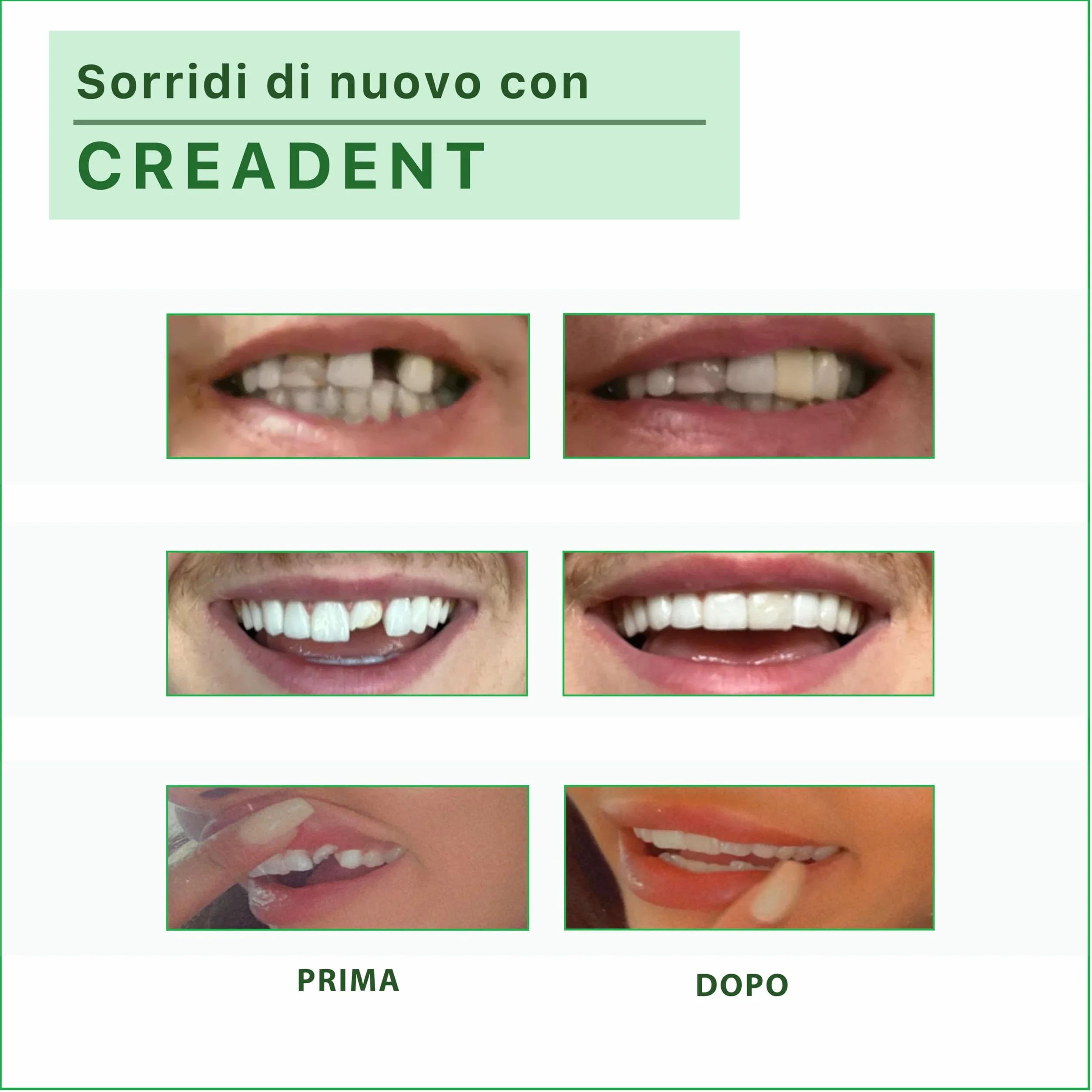 Creadent Kit per Sostituire un Dente Mancante